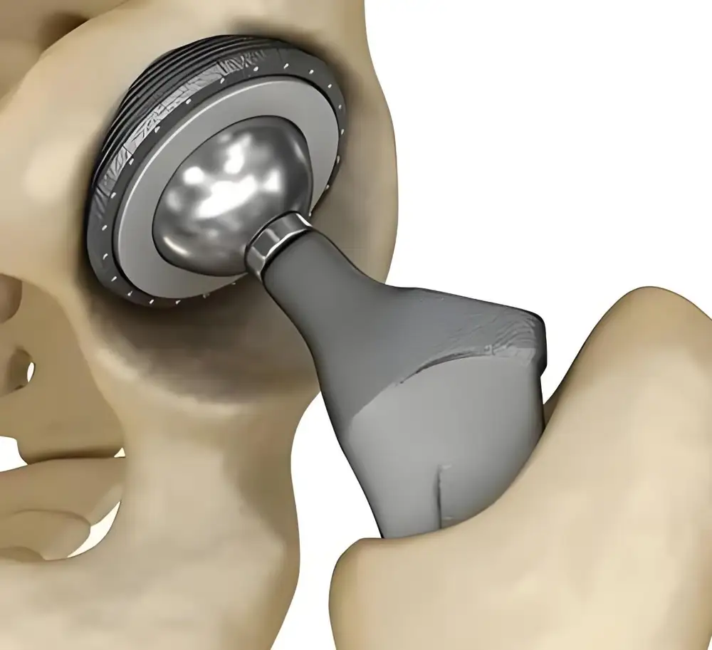 Implantable Devices