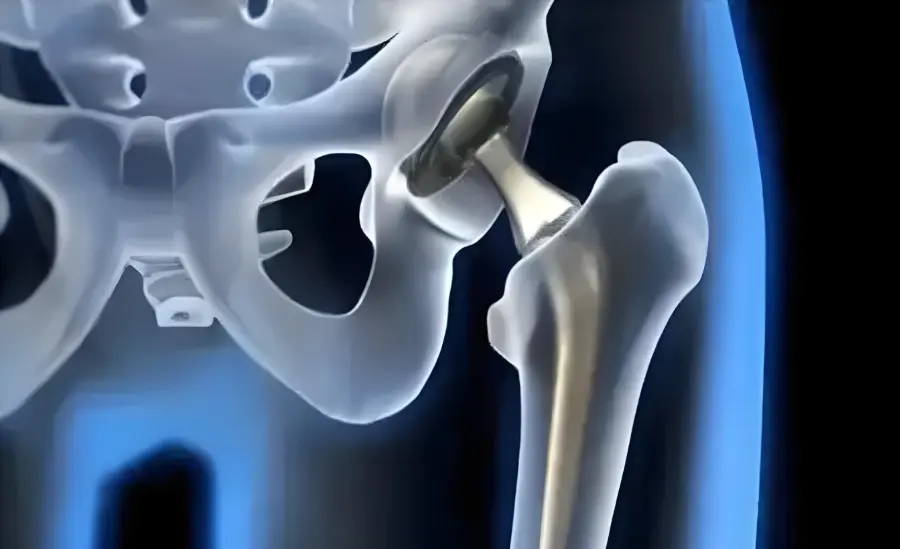 Implantable Medical Devices Types, Materials, and Manufacturing