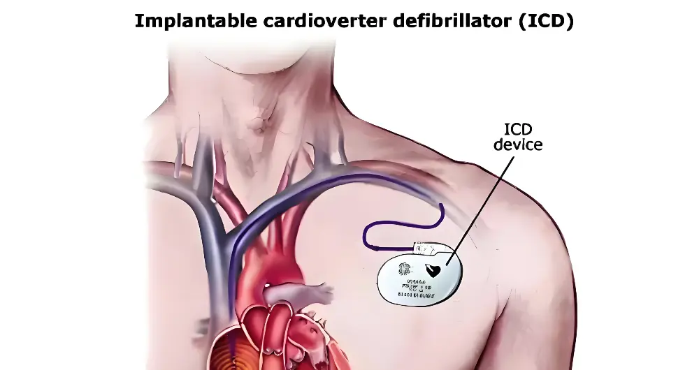 Implantable cardioverter defibrillators (ICDs)