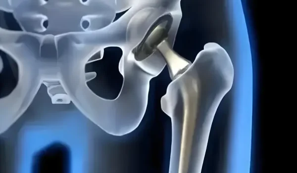 Implantable Medical Devices Types, Materials, and Manufacturing